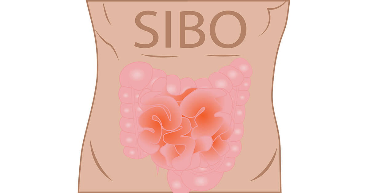 SIBO: What causes small intestinal bacterial overgrowth & Functional Medicine approach to SIBO