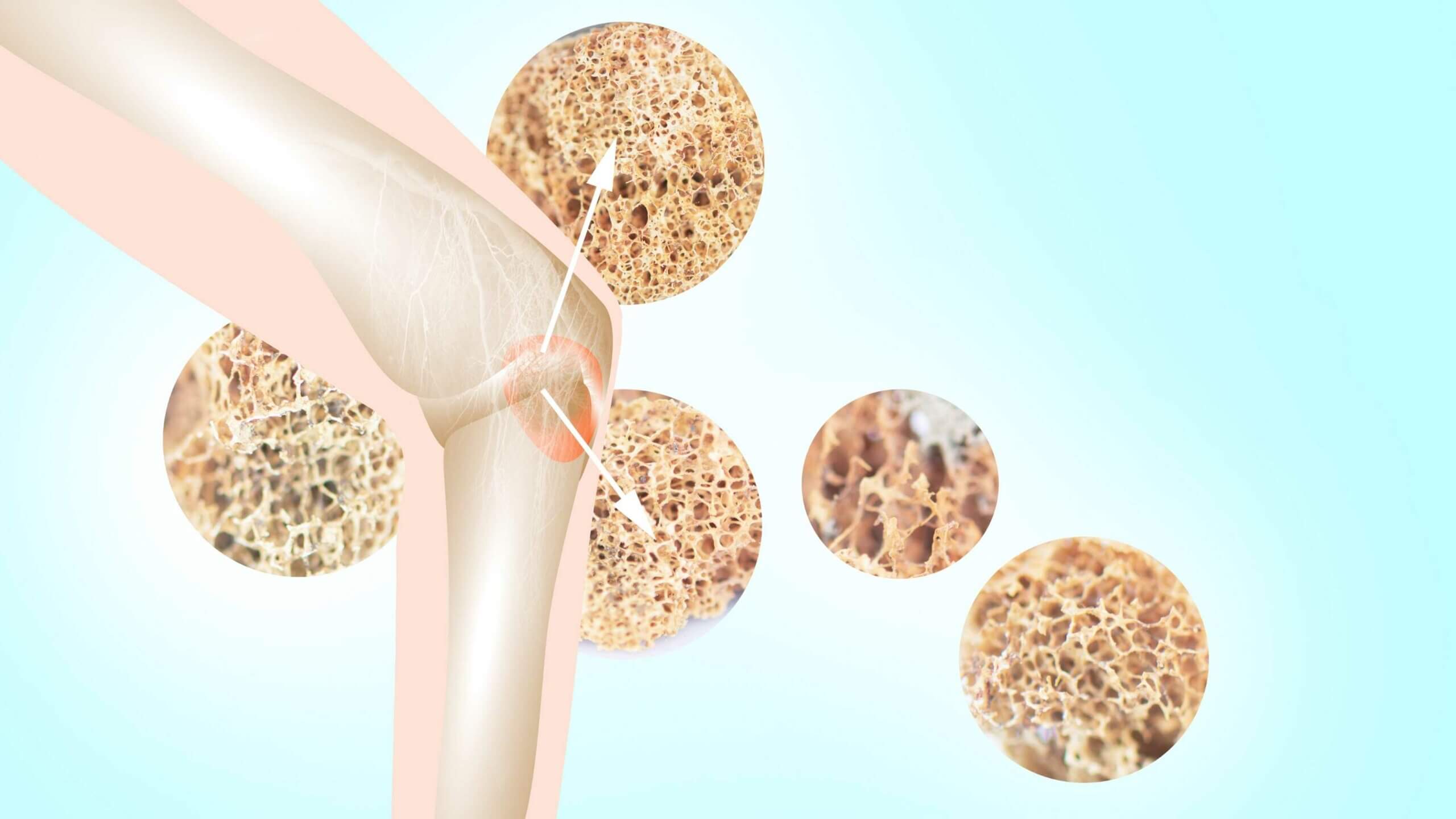 Preventing Osteoporosis The Natural Way